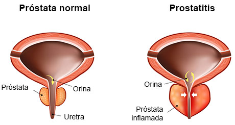 Infografía de prostatitis