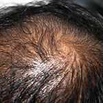 Ejemplo de Alopecia Seborreica