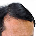 Hombre que padece Alopecia androgenetica 