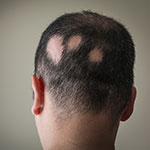 Ejemplo de Alopecia Areata