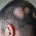 Hombre que padece Alopecia areata