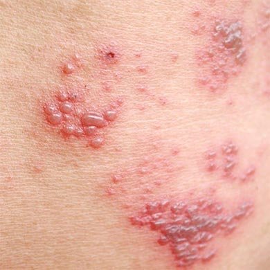 ¿Qué Es La Psoriasis?