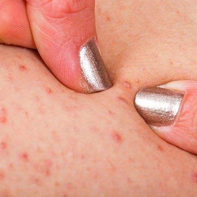 Tratamientos para la Foliculitis
