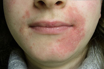 Mujer con problemas de rosacea alrededor de la boca