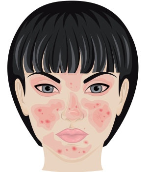 Dibujo de mujer con problemas de rosacea en los ojos