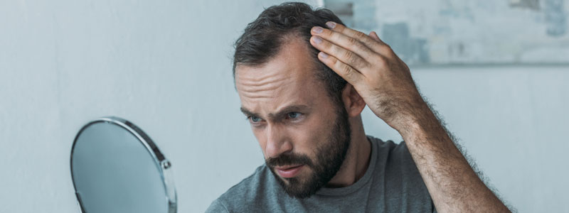 Hombre joven que está empezando a sufrir de Alopecia