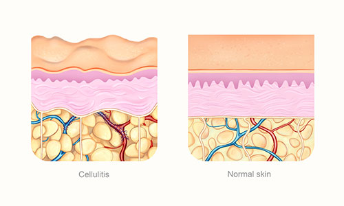 Grafico en color de un trozo de piel con celulitis