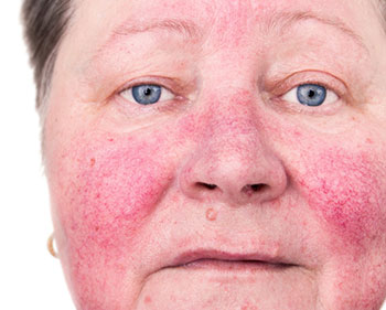 Mujer con problemas de rosacea en la nariz