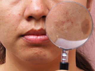 imagen melasma