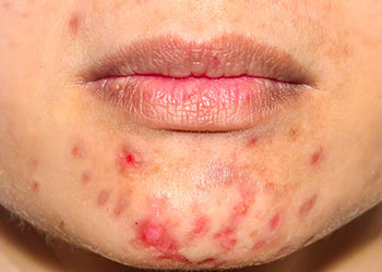 Mujer con problemas de rosacea alrededor de la boca tipo acne