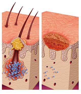 Ilustración de la foliculitis