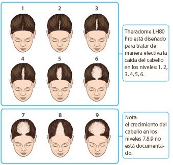 Imagen para ver los niveles de alopecia donde el casco Theradome es más efectivo